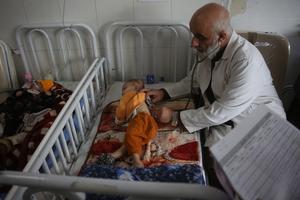 AFGANISTAN-KABUL-NIÑOS DESNUTRIDOS